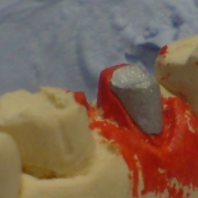 Установленная культевая вкладка