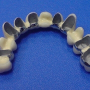 Мостовой протез