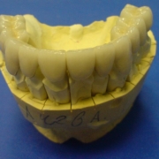 Мостовой протез. Слепок